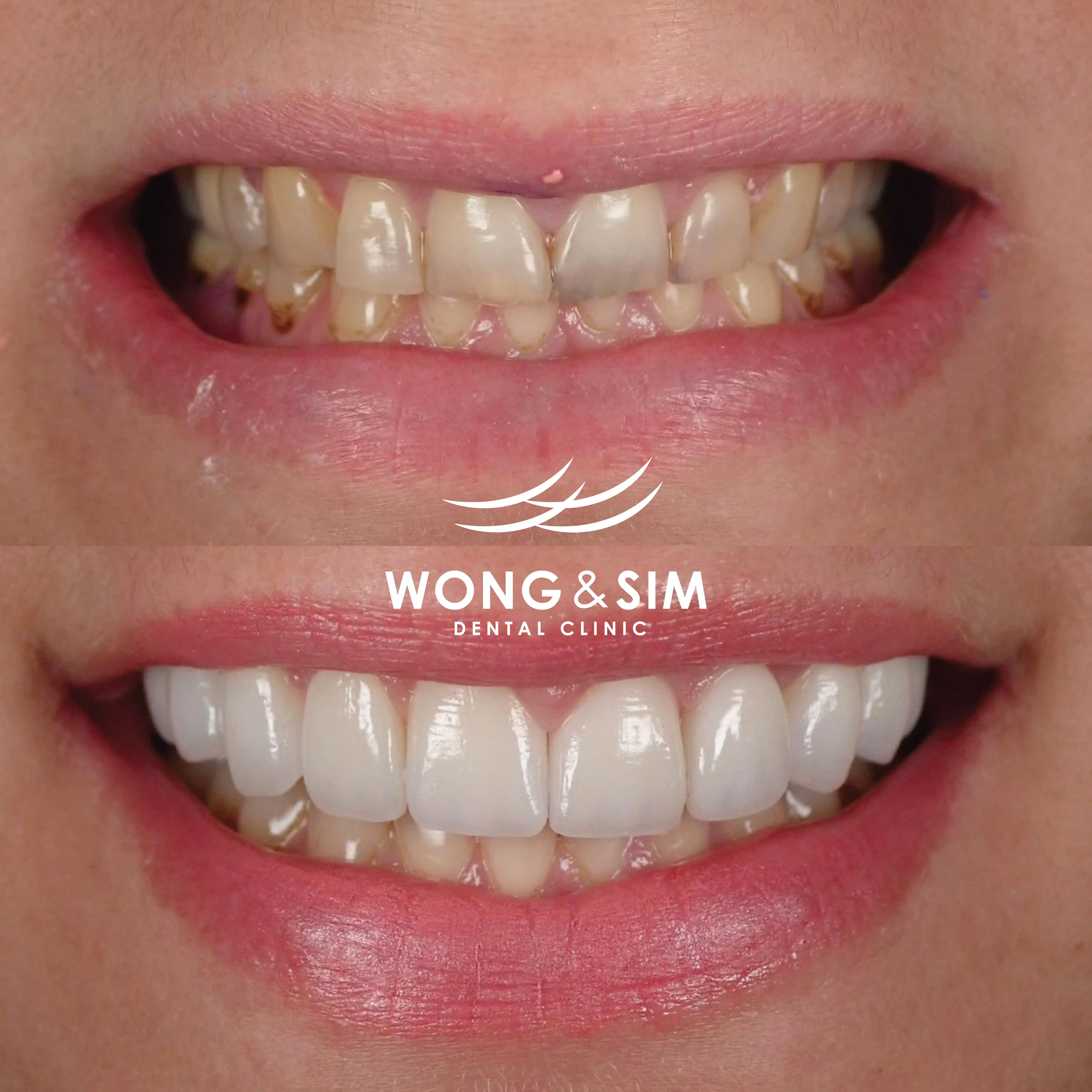 Patient 6 - Veneers Before and After